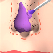 挤黑头大师安装包